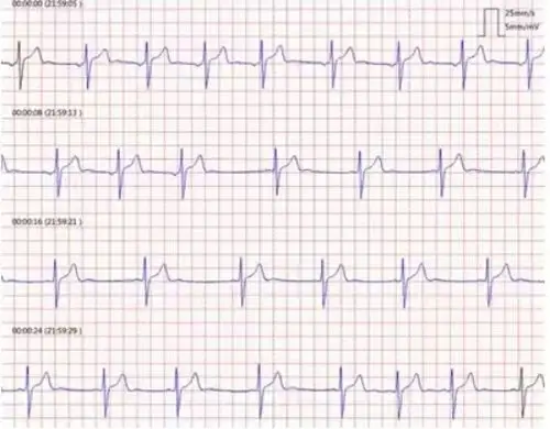体检心电图查出"窦性心律不齐",问了医生才知道