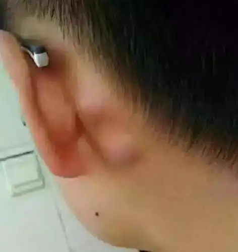 耳朵后面长"小包",不经意间竟然是肿瘤!