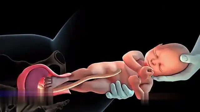 5,胎儿娩出之后,宣告第二产程的结束,正式进入第三产程——胎盘娩出期