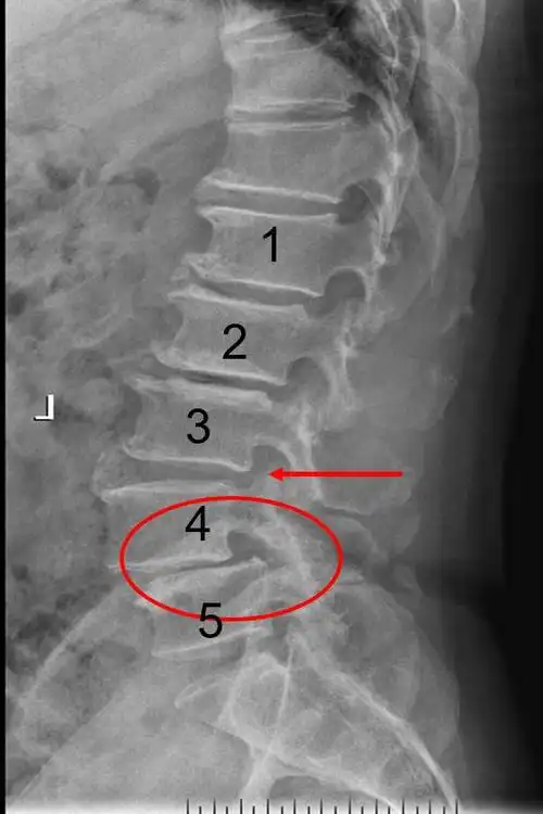 【超能刀客】"止麻先锋"故事会│018号 腰椎退行性病变诊治病例汇报
