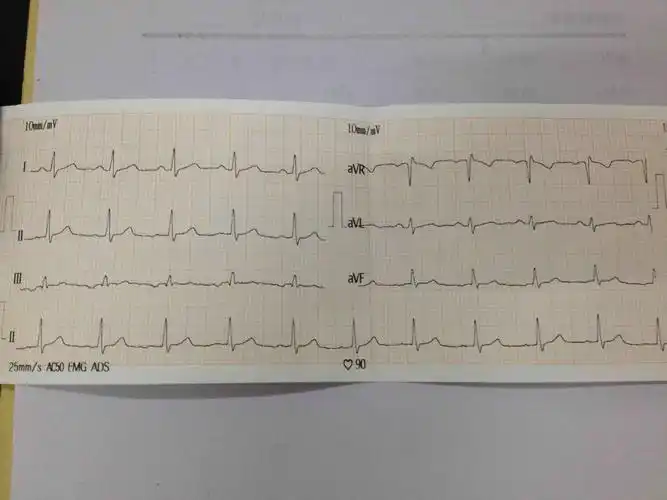 阵发性室上速 - 心电图脑电图专业讨论版 - 爱爱医医学论坛