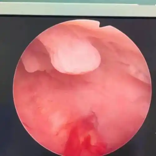 阴道淋漓出血3个月,原来竟是子宫内膜息肉!_刘女士_女性_情况