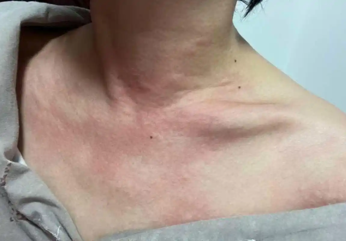 最近身上总是这样一片一片的起红疙瘩是怎么回事?