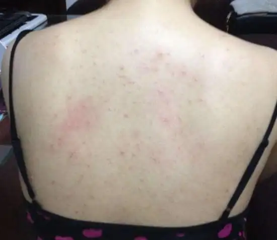 胸前背后起红疹多数都因螨虫作祟3招教你清除9层以上螨虫