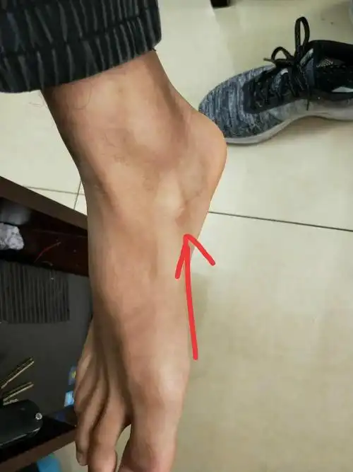 如何判断是否为舟骨的异常增大