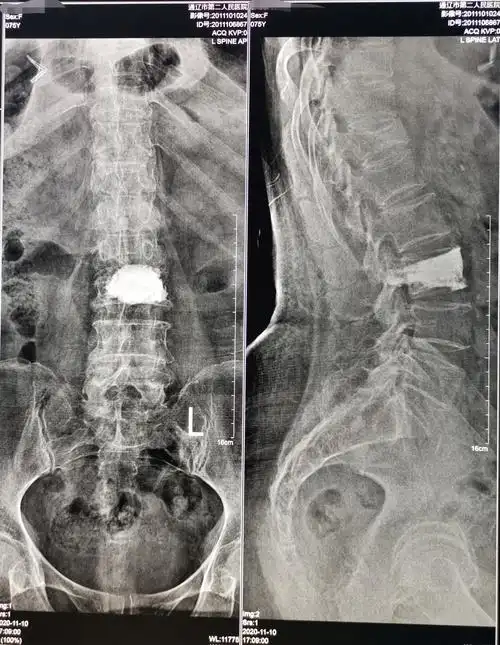 75岁腰椎压缩性骨折患者椎体成型手术一例