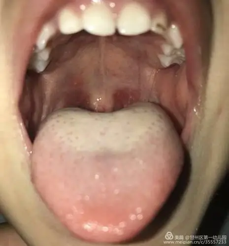 的是,咽峡充血特别明显,舌腭弓,软腭,硬腭及悬雍垂处有浅灰色的小疱疹