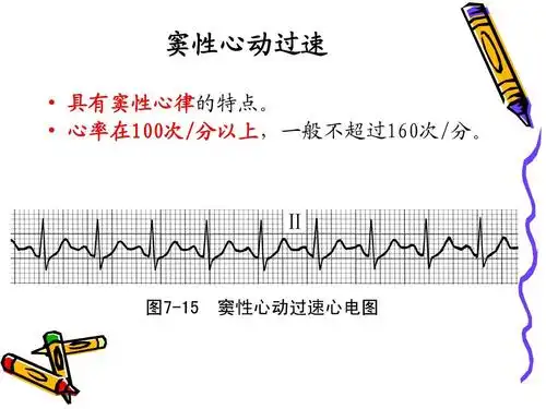 窦性心动过速   具有窦性心律的特点.