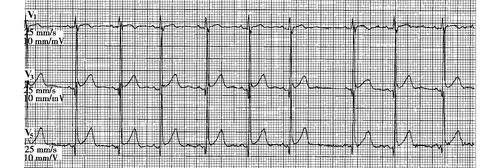 窦性心律不齐有什么严重危害吗