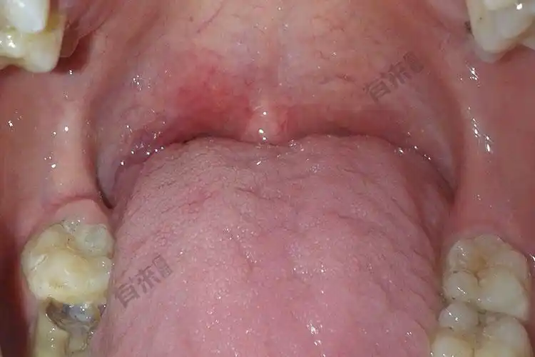 出麻子初期症状图片