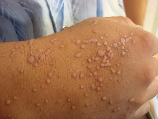 扁平疣发病时表现有哪些?