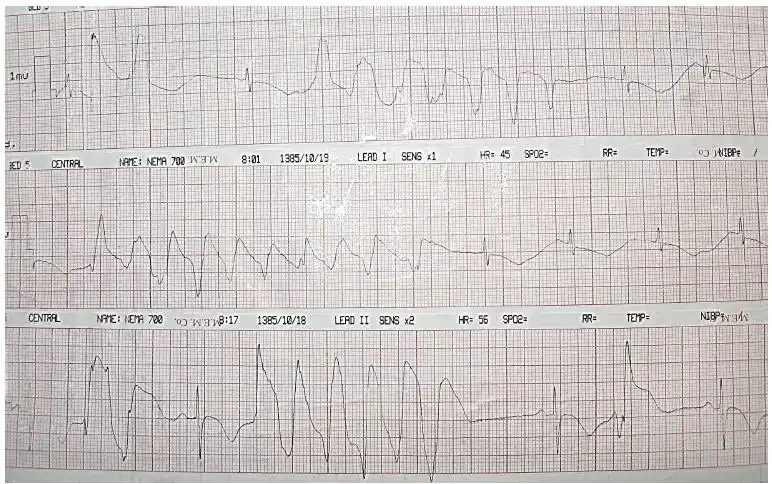心电图示尖端扭转型室速
