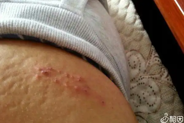 7种女人容易患上宫颈癌,生殖性疱疹患者几率更高