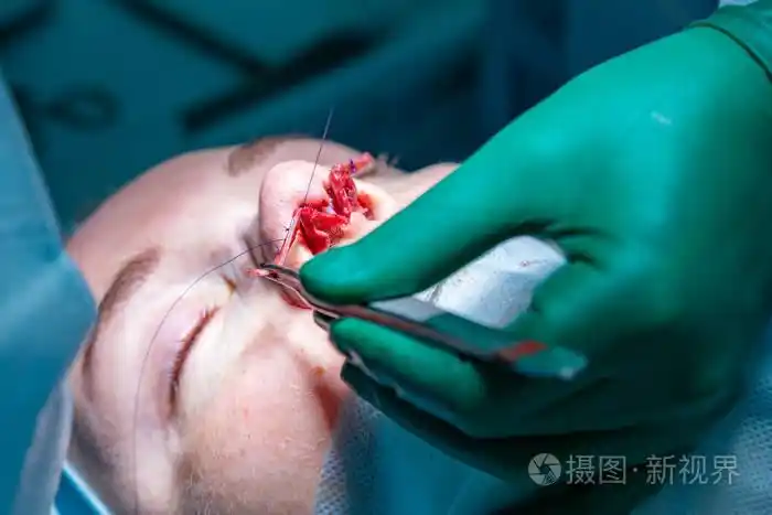 外科医生和他的助手执行整容手术在医院手术室的鼻子上.鼻整形, 隆胸.