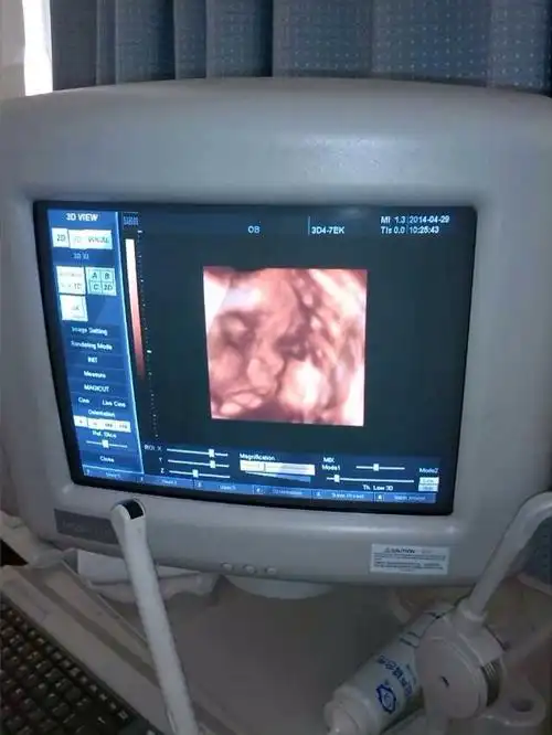 看一下宝宝的这张四维彩超照片有没有兔唇