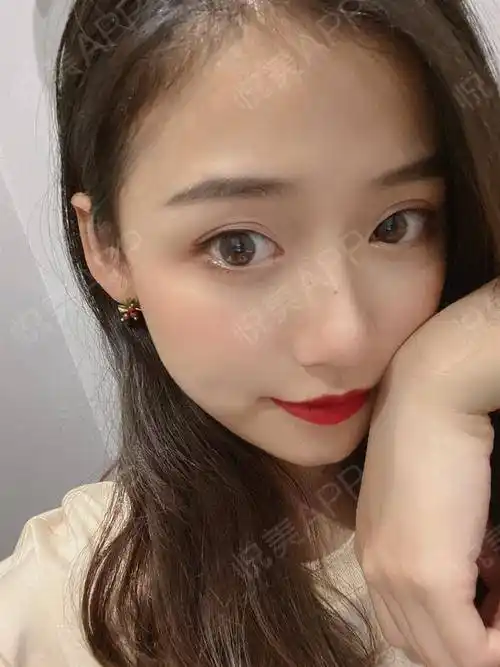 之前做手术的时候就跟徐医生说过要做个较自然的双眼皮,现在效果就