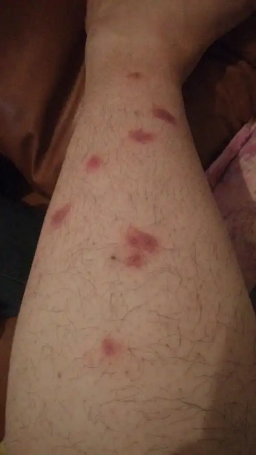 小腿上长红包,又硬又痒,另一条腿也有,很对称,现在开始蔓延到大腿和