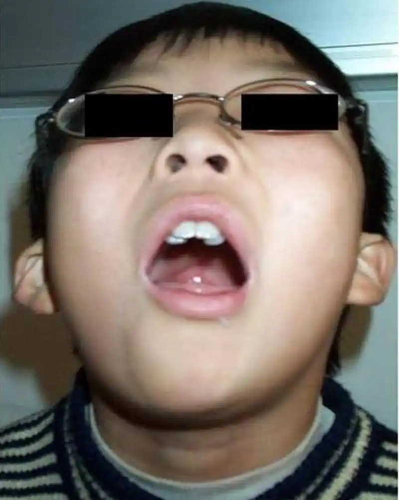 中医如何看待小儿腺样体肥大,又如何辨证施治?