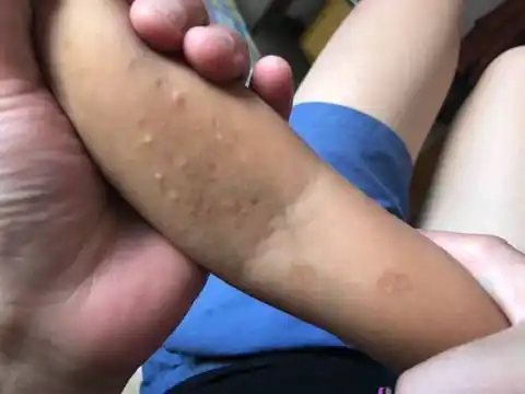 两岁多宝宝得软疣怎麼办