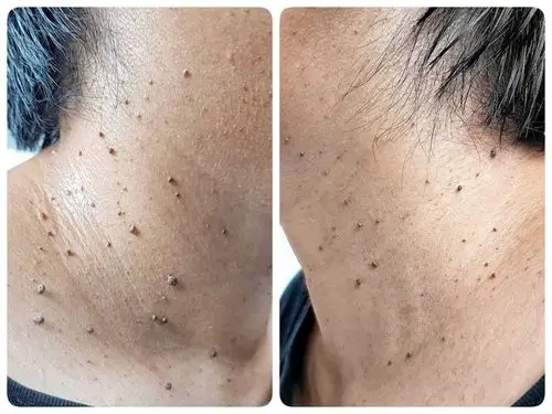 皮肤息肉治疗 – 医专荟皮肤疣资讯中心