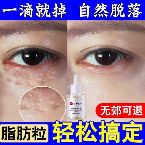 脂肪粒汗管瘤眼部去除神器专用男女针眼角眼周眼下眼霜精华液仁和