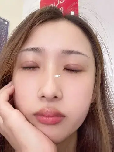 双眼皮第15天_双眼皮_开眼角_焦虑_美妆_医美整形