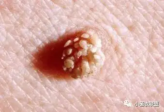 表现为单纯性角化,待侵及皮肤时才出现典型赘疣状损害