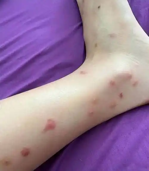 被虱狂咬1个月 朱智贤饱受失眠引发噩梦_都会_后遗症_照片