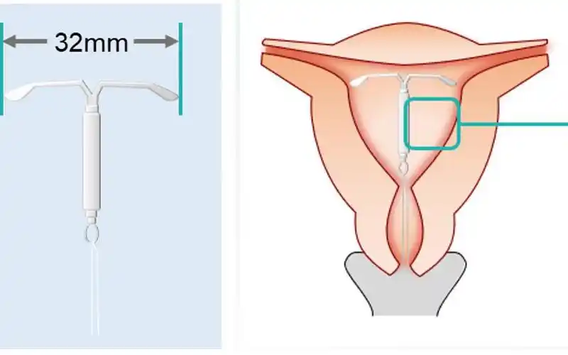 机体的子宫内膜异位和腺肌病有明显的治疗作用,所以说曼月乐环还是