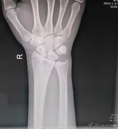 腕舟骨骨折