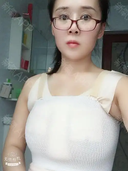 放了假体做了提升胸部果然厉害,一点点下垂感都没有  术后没有多大