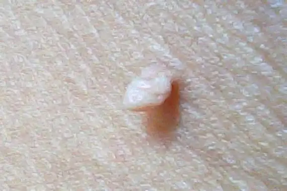 长个小肉揪怎么回事