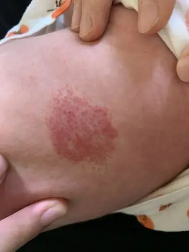 具有一定厚度,血管瘤处皮肤温度增高,可考虑局部注射治疗