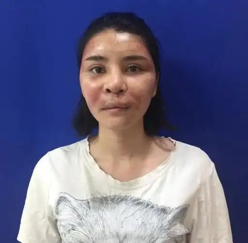 这个兔唇女孩的症状没有那么的严重,但是兔唇并不是非常的好看,甚至有