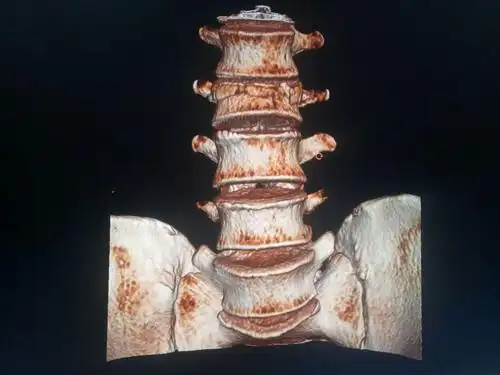 腰椎压缩性骨折