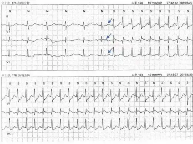 房室|心动|心电图|窦房结|心律失常|甲状腺结节_网易订阅