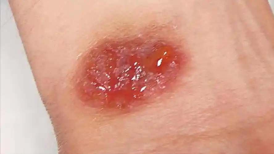 (4)皮损特点为红斑,水肿,在此基础上出现针尖至粟粒大丘疹,丘疱疹