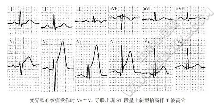 【附图】 t波高耸 _心电图学 | 天山医学院