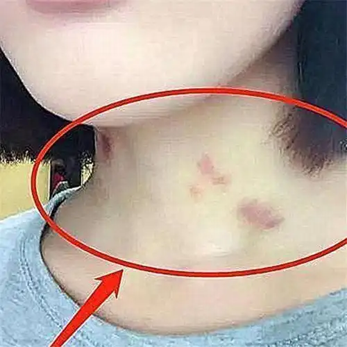 女儿说胸里有硬块一大一小(妈妈发现11岁女儿脖子上有)(2)