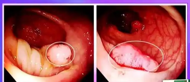 1,直肠癌高发,肛门指诊别放弃