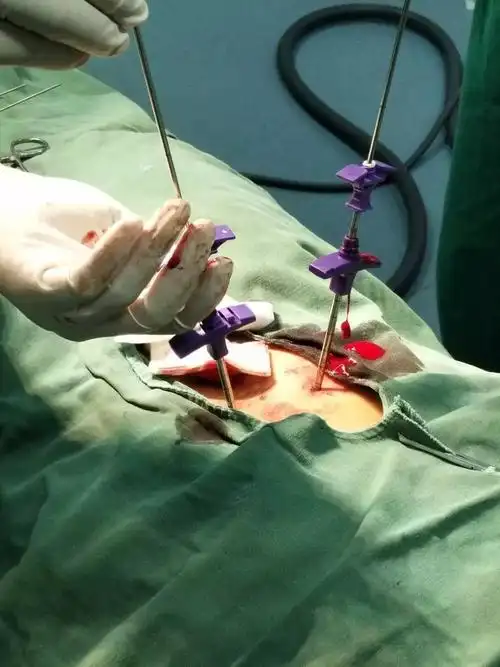 我院骨科成功完成一例经皮穿刺椎体成形术_腰椎