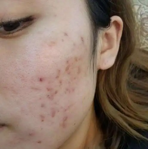 长螨虫的脸, 有3症状根本藏不住, 过半国人都有, 赶紧自查一下