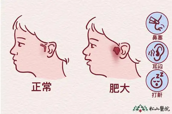 腺样体肥大.重庆松山医院供图