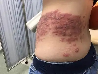 女孩听我说完,很疑惑:"不是听说带状疱疹都是老年人才得吗?