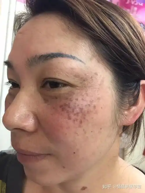 祛斑小课堂如何判别自己脸上斑的种类