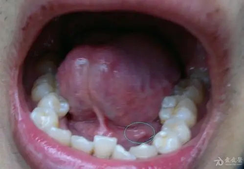 口腔有增生物,求求你们