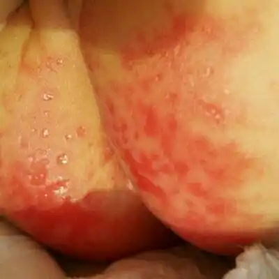 宝宝二十天了,红屁屁特别严重,之前用的是尿布,现在换用纸尿裤了还是