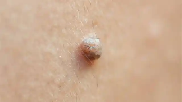 脖子上长出"小肉粒",不只是影响美观那么简单,问题可能还不小|粉刺