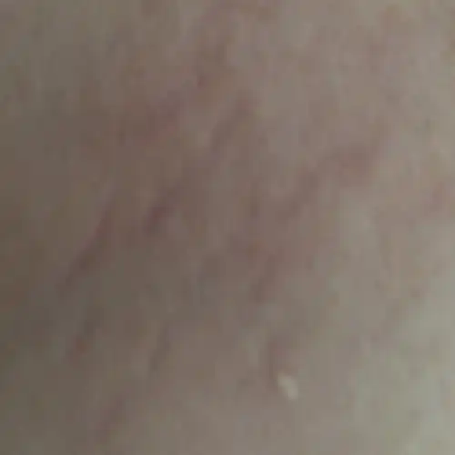 胸上为什么会长妊娠纹 胸上为什么也会长妊娠纹