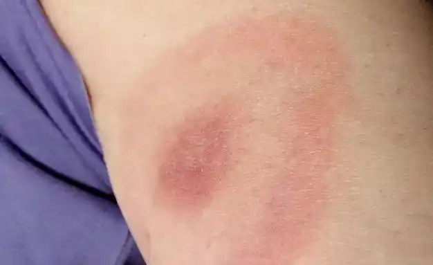 死亡人数已达4人!致死率高达30%,被夺命蜱虫咬了,该如何自救?